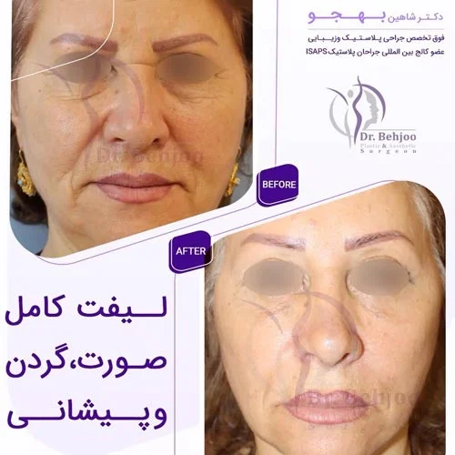 لیفت-کامل-صورت،-گردن-و-پیشانی.webp
