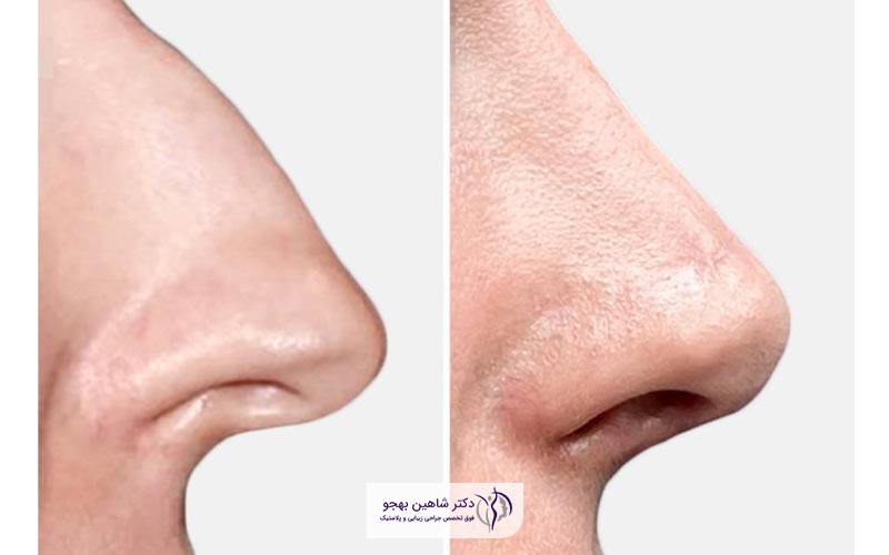 تصویر و عکس نمونه کار عمل بینی ترمیمی و زیبایی طبیعی بینی استخوانی و غضروفی قبل و بعد