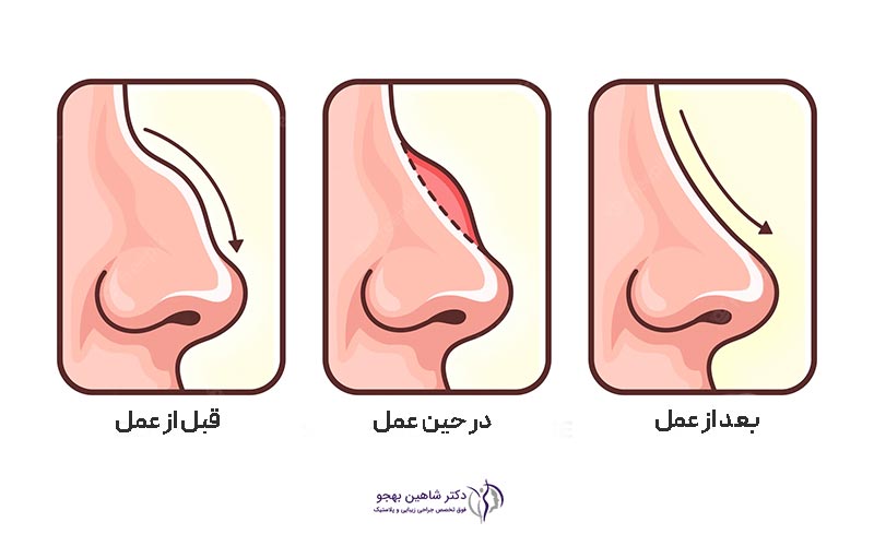 عمل جراحی بینی استخوانی چگونه انجام میشود