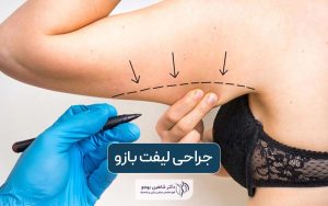 جراحی لیفت بازو چیست؟ هزینه عمل براکیوپلاستی در تهران و عوارض و خطرات آن