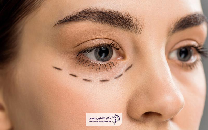 نکات و آمادگی های قبل از عمل زیبایی پلک