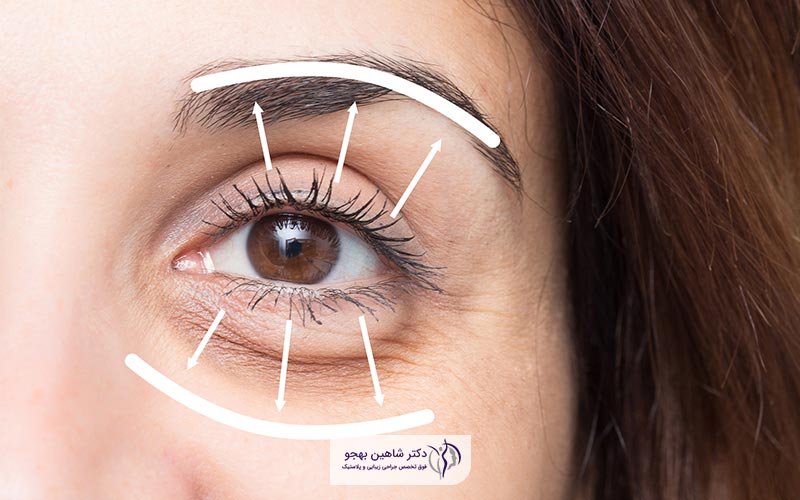 جراحی بلفاروپلاستی یا عمل پلک زیبایی و ترمیمی چیست