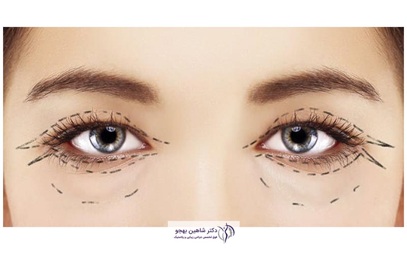 مراحل جراحی بلفاروپلاستی در اتاق عمل