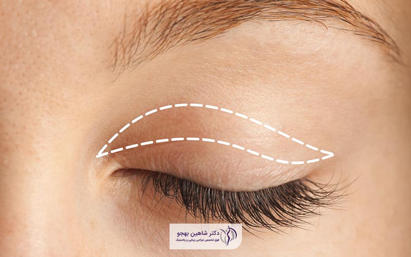 هزینه جراحی بلفاروپلاستی (قیمت عمل پلک) توسط پزشکان در تهران