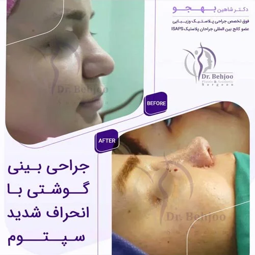 عمل بینی گوشتی دارای انحراف