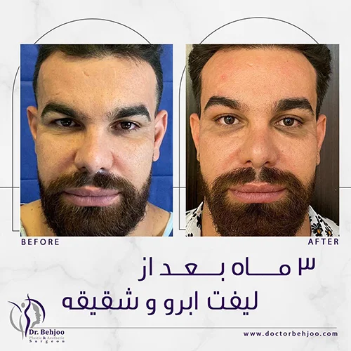 نتیجه جراحی لیفت ابرو و شقیقه بعد از 3 ماه