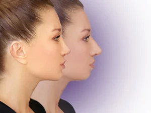جراحی زیبایی چانه