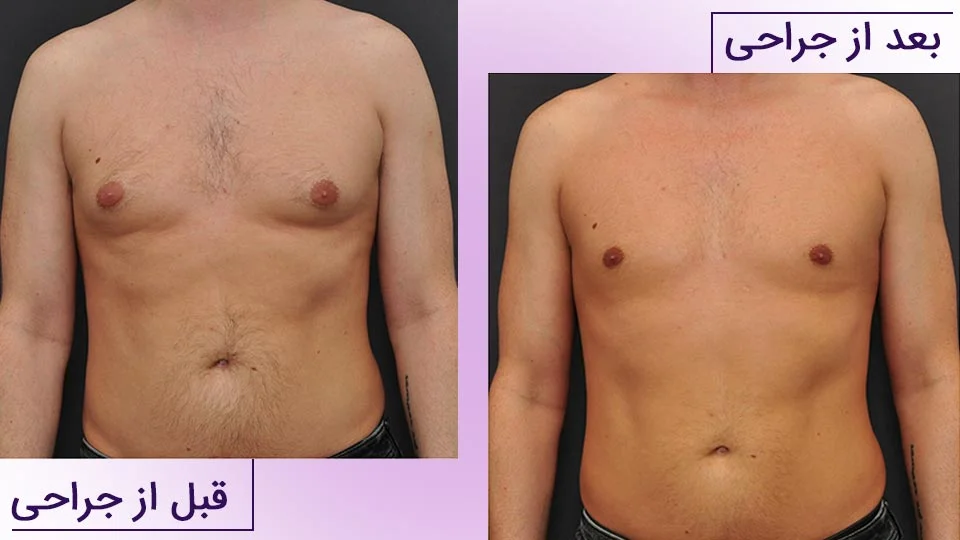 قبل و بعد جراحی ژنیکوماستی