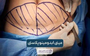 مینی ابدومینوپلاستی یا مینی تامی تاک چیست و چه تفاوتی با ابدومینوپلاستی کامل دارد