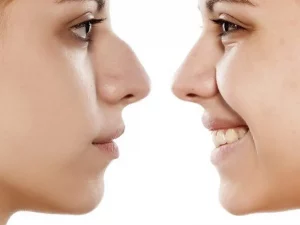 عمل قوز بینی