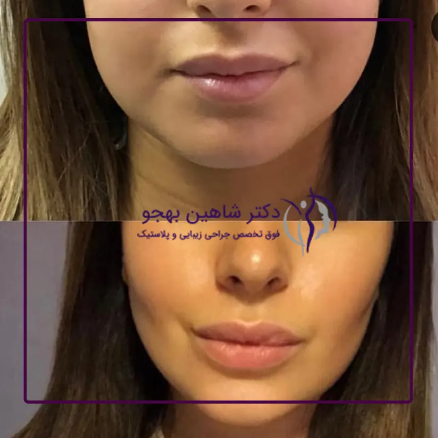 لیپوماتیک صورت