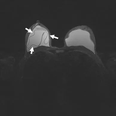 پارگی-پروتز-سینه