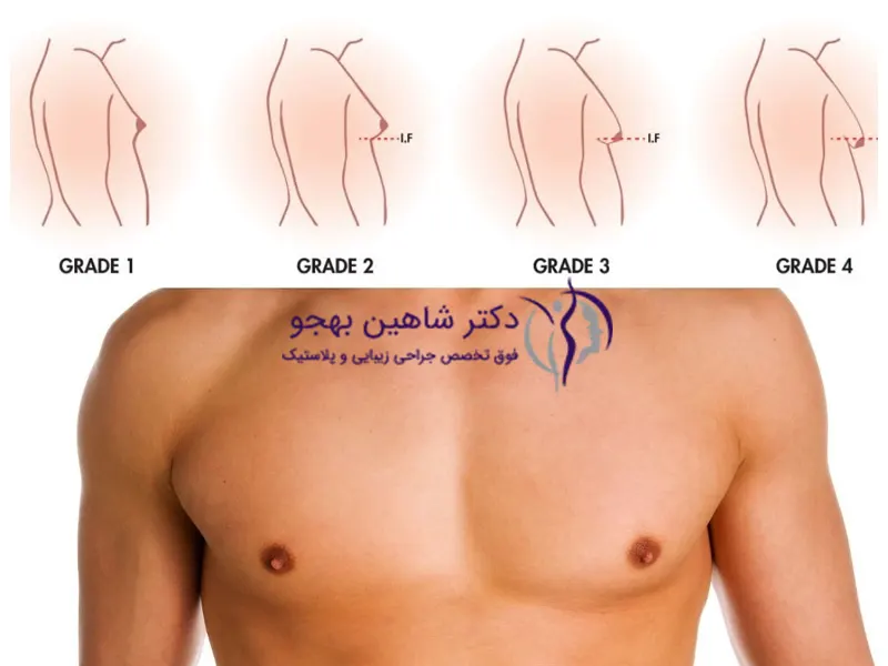 درجات-مختلف-ژنیکوماستی