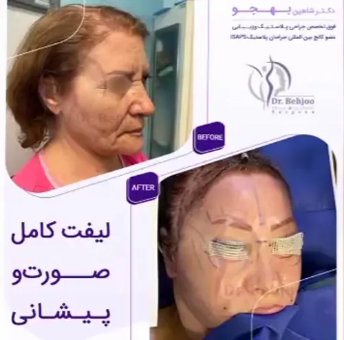 لیفت-صورت