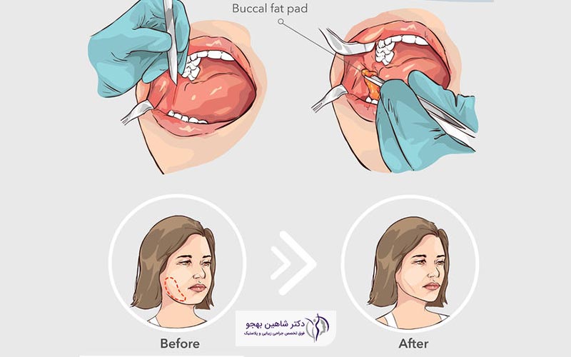 مراحل و نحوه چگونگی عمل جراحی تخلیه چربی گونه و دهان یا لیپکتومی بوکال
