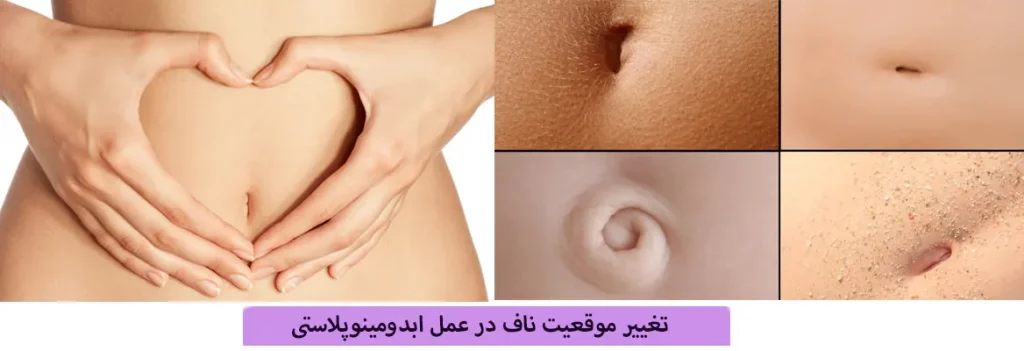تغییر-موقعیت-ناف-در-عمل-ابدومینوپلاستی