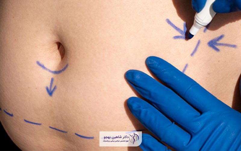 عوارض ابدومینوپلاستی (جراحی زیبایی شکم) چیست
