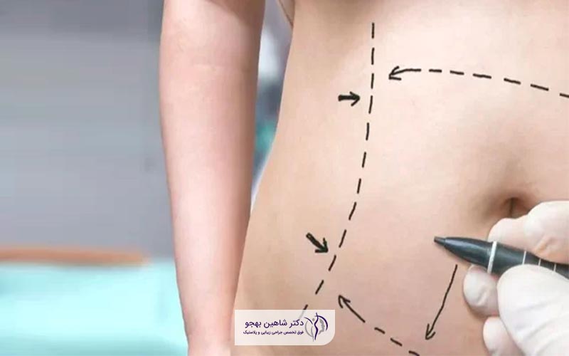 استعمال دخانیات یکی از عواملی است که خطر جراحی ابدومینوپلاستی را افزایش می دهد