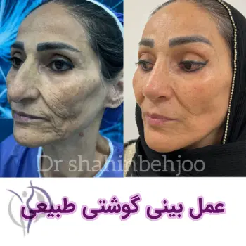 نمونه عمل بینی گوشتی