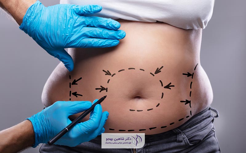 ابدومینوپلاستی یا جراحی شکم (عمل زیبایی شکم) چیست و چه کاربردی دارد