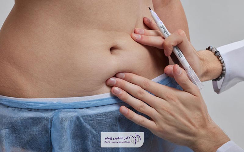 هفته اول از مراقبت های بعد از عمل جراحی ابدومینوپلاستی (شکم) و نکات آن