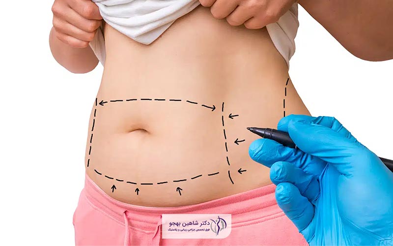 هزینه عمل ابدومینوپلاستی در سال ۱۴۰۳ + جدول قیمت آن