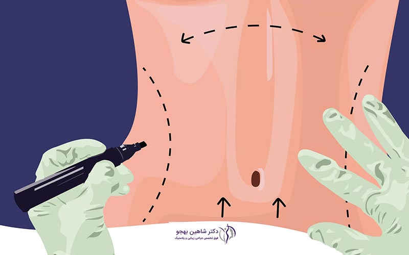 عوامل موثر بر قیمت عمل جراحی زیبایی شکم یا تامی تاک در تهران سال 1403