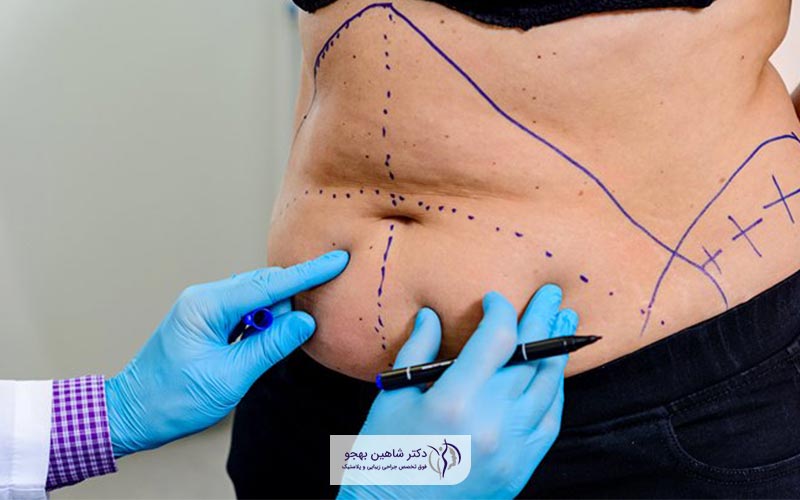 جراحی ابدومینوپلاستی یا عمل زیبایی شکم چیست
