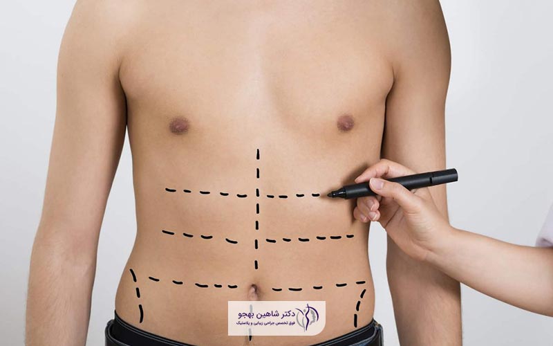 عمل جراحی لیپوماتیک برروی شکم مرد و زن جیست