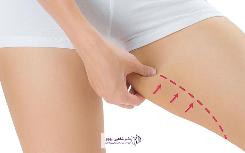 قیمت عمل جراحی لیپوماتیک ران در خانم ها و آقایان