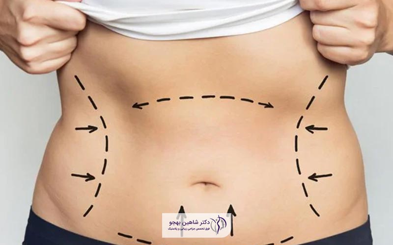 هزینه عمل لیپوماتیک در سال 1404 و عوامل موثر بر قیمت جراحی لیپو