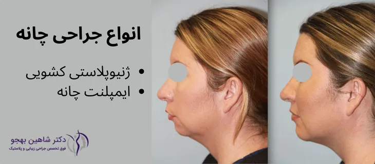 انواع جراحی زیبایی چانه، دو روش ژنیوپلاستی کشویی و ایمپلنت چانه هستند.