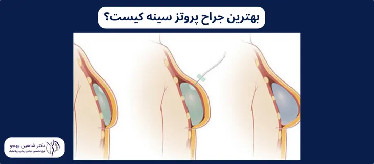 بهترین جراح پروتز سینه کسی است که با مهارت و تجربه بالا نتیجه ایده‌آلی را به بیمار خود می‌دهد.