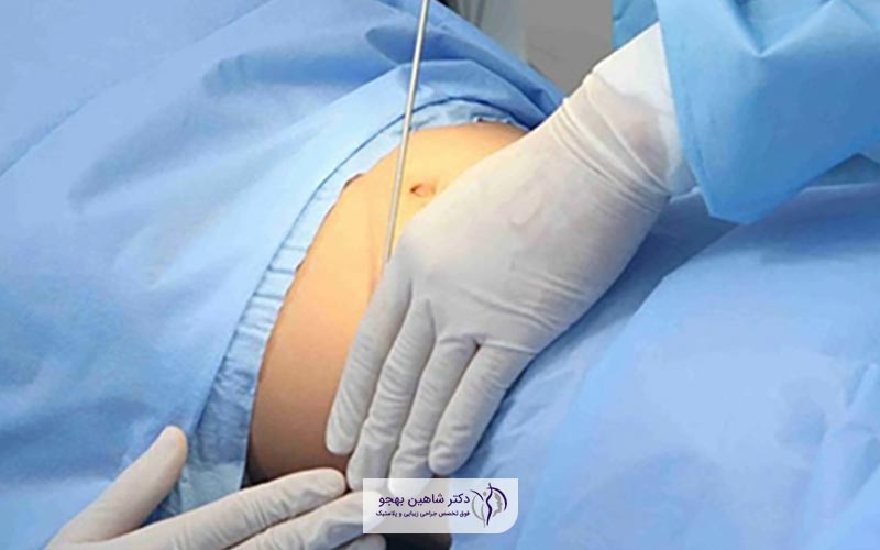 تحت پوشش قرار دادن هزینه پیکر تراشی در ایران توسط بیمه