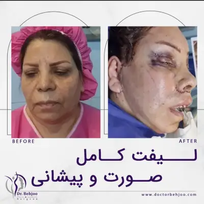 لیفت صورت بعد عمل
