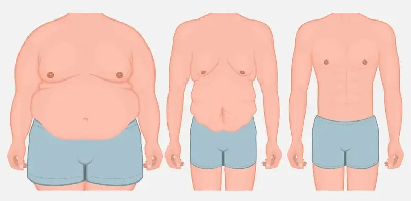 تفاوت ابدومینوپلاستی و لیپوماتیک