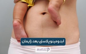 ابدومینوپلاستی بعد زایمان؛ سزارین بعد از ابدومینوپلاستی شدنی است؟