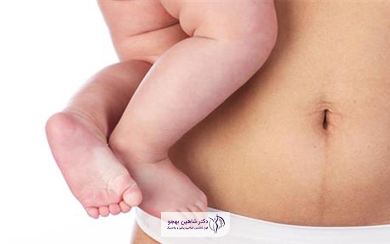 هدف ابدومینوپلاستی بعد از زایمان طبیعی و سزارین چیست