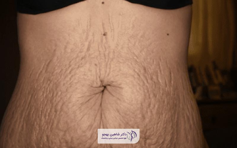 مزایای جراحی زیبایی شکم بعد از زایمان طبیعی و سزارین