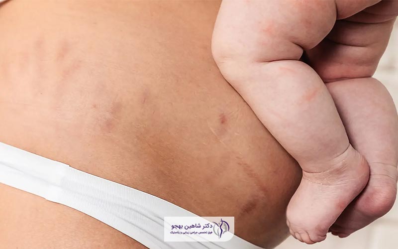 آیا زایمان سزارین بعد از ابدومینوپلاستی شکم امکان دارد و شدنی است؟