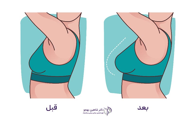 قیمت جراحی پروتز سینه در سال ۱۴۰۴ و عکس قبل و بعد از آن