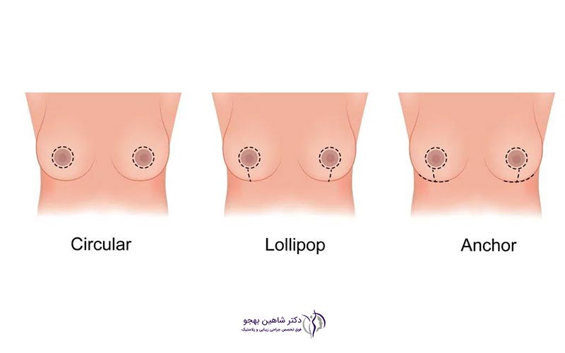 انواع ماموپلاستی کاهشی، افزایشی و ترمیمی و نحوه عمل آن