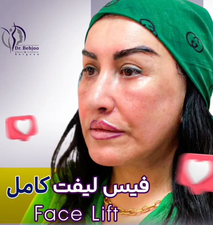 لیفت کامل صورت