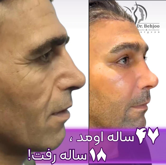 لیفت کامل صورت