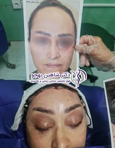 جراحی تراش استخوان پیشانی