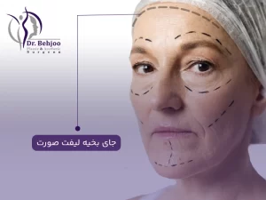 جای بخیه لیفت صورت