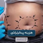 هزینه پیکرتراشی و قیمت کانتورینگ بدن در سال 1403
