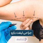 جراحی لیفت بازو چیست؟ هزینه عمل براکیوپلاستی در تهران و عوارض و خطرات آن