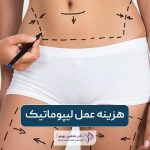 هزینه عمل لیپوماتیک در سال 1404؛ قیمت جراحی لیپو و عوامل موثر بر افزایش آن