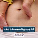 ابدومینوپلاستی بعد زایمان؛ سزارین بعد از ابدومینوپلاستی شدنی است؟